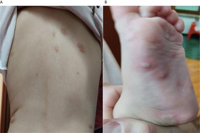 Case Report and Review of the Literature: Bullous Skin Eruption After the Booster-Dose of Influenza Vaccine in a Pediatric Patient With Polymorphic Maculopapular Cutaneous Mastocytosis